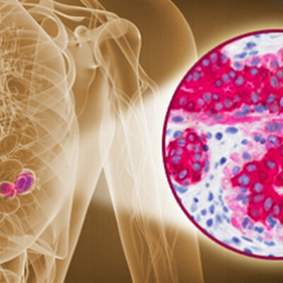 Timeline: “Evaluación in vitro de terapia antitumoral adyuvante:Hipertermia magnética en células fluorescentes de cáncer de mama”