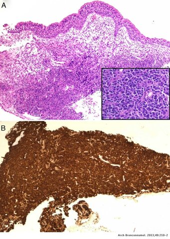 Rituximab para el linfoma de células B