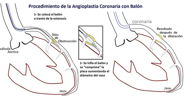 primera angioplastia coronaria exitosa