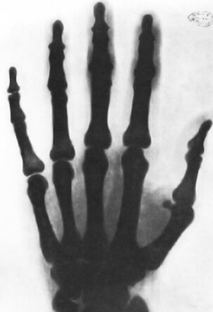 X-ray