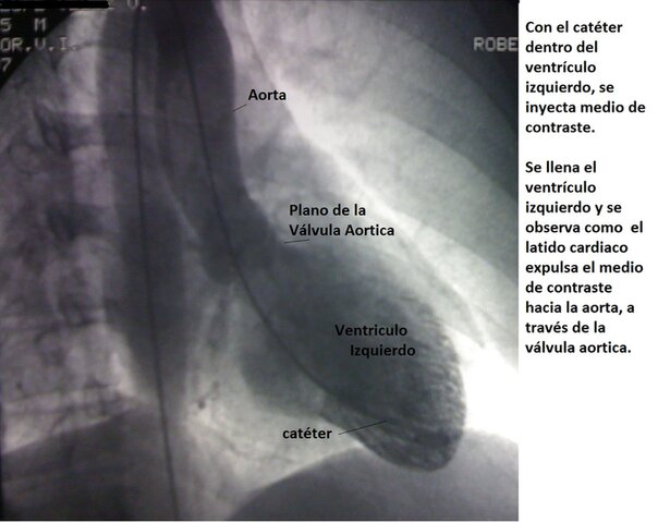 EL PRIMER CATETERISMO RETROGRADO DEL VENTRÍCULO IZQUIERDO