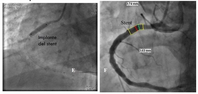 UTILIZACIÓN DEL STENT LIBERADOR DE FÁRMACOS