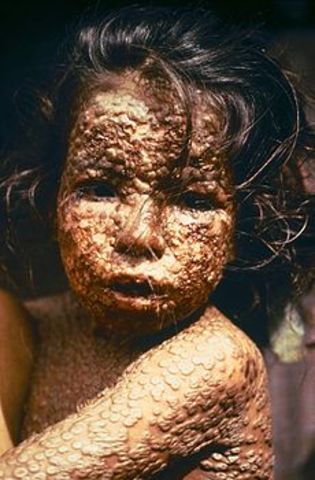 Smallpox begins to destroy natives