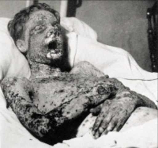 Smallpox, not such a small disease