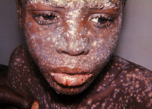 Smallpox