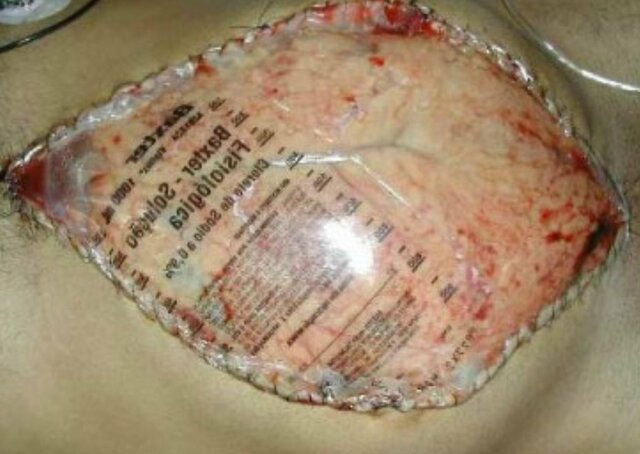 Uso de la bolsa de Bogotá para contener las vísceras abdominales