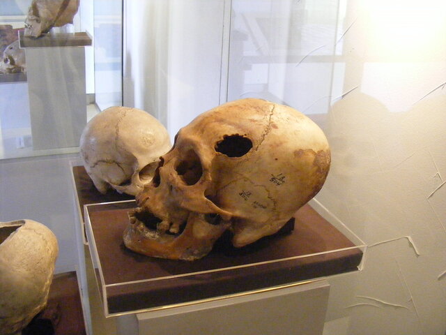 Trepanación