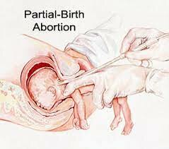 Partial Birth Abortion