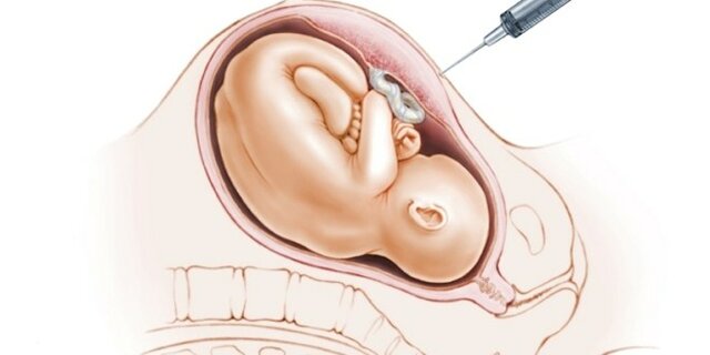 1981 Diagnóstico Prenatal