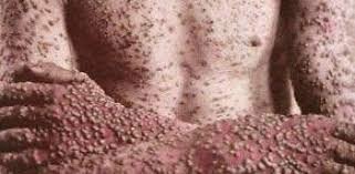 Inicio de la pandemia de la viruela