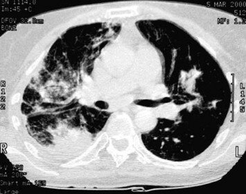 vacuna contra Neumococo