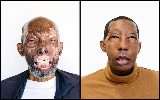 Face Transplants