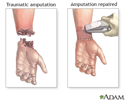 Limb reattachments