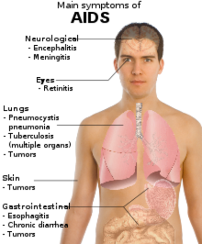 A Aids é diagnosticada