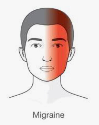 Migraines