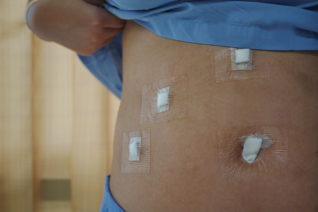 Laparoscopic surgery