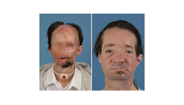 Face transplant