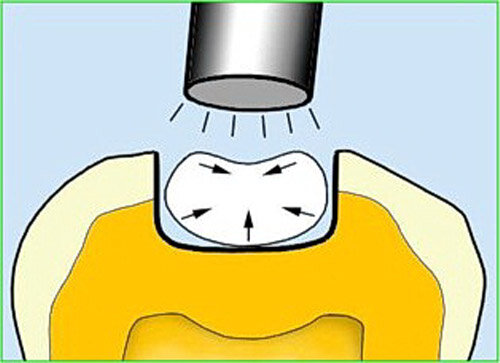 Resinas con adhesión a dentina