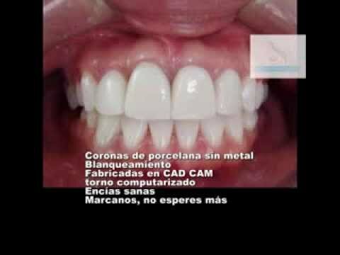 Primera corona encamisada de porcelana sin metal.