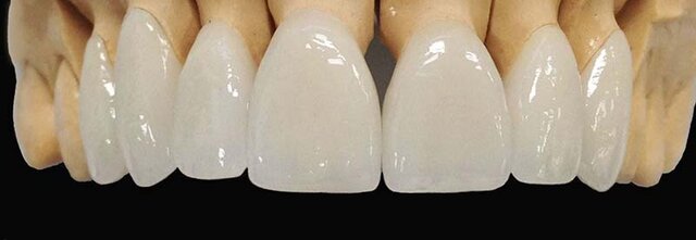 Primera corona con revestimiento de porcelana totalmente cerámica