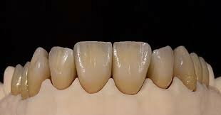 Ceramica moldeable (Dicor)