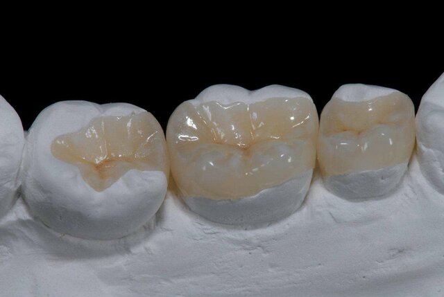Se introduce el sistema de incrustaciones cerámicas Cerec
