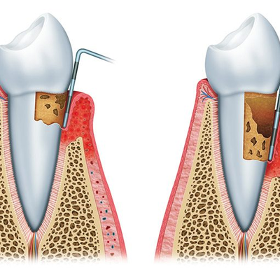 Timeline: PERIODONTITIS (De la cruz Santana Rocio) 5toB