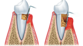 Timeline: PERIODONTITIS (De la cruz Santana Rocio) 5toB