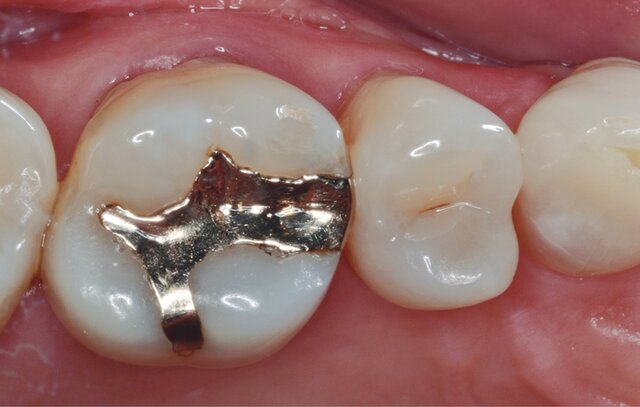 El Dr. William Youdelis desarrolla la amalgama con alto contenido de cobre que mejora la integridad marginal