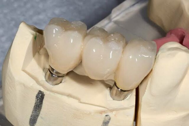 Zirconia in-ceram
