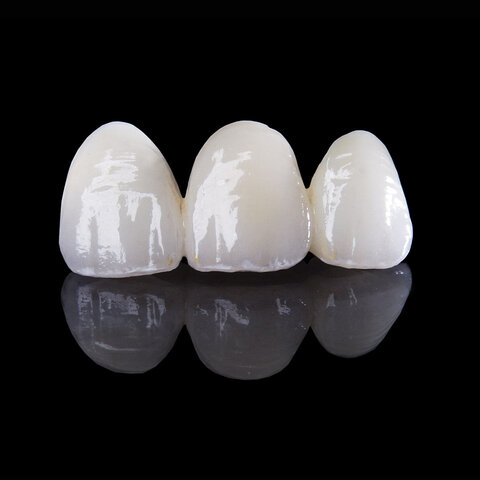 Se introdujeron las restauraciones de cerámica sin metal