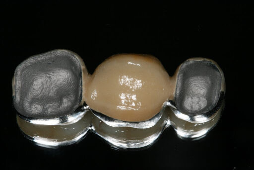 Sistema Metal - Cerámica