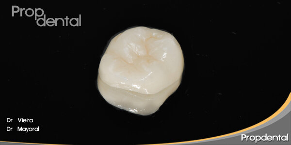 Incrustación de Cerámica Bidimensional