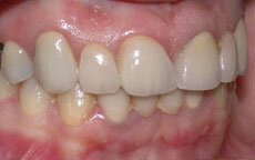 Restauraciones de cerámica sin metal