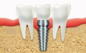Técnicas de osteointegración