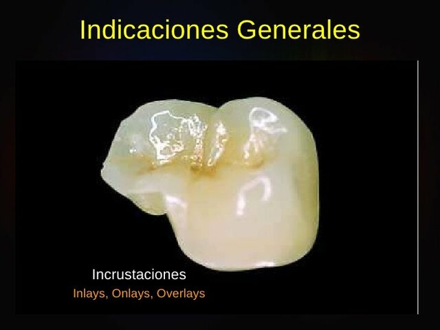 Incrustación tridimensional