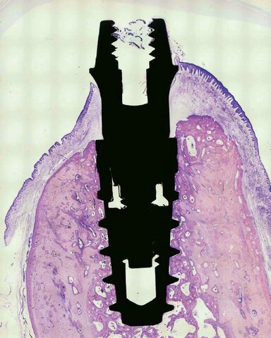 Oseointegración de Implate