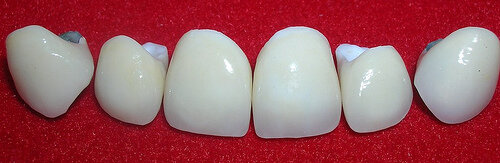 Primeras coronas de porcelana sin metal