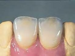 Vita In-Ceram Spinell