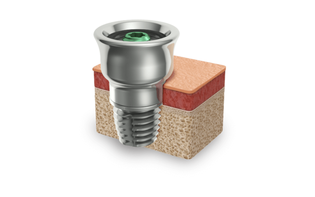 Era de la Implantología Moderna