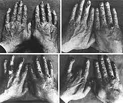 Se registra una de las primaras muertes por radiación