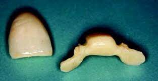 Resina compuesta reforzada