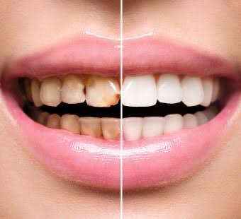 En la odontología, la cerámica se introdujo por primera vez como materiales de restauración