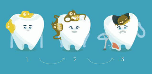 Se empezaron a fluorar aguas potables para reducir caries.