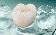 Dr. Charles Land patentó las primeras coronas de cerámica