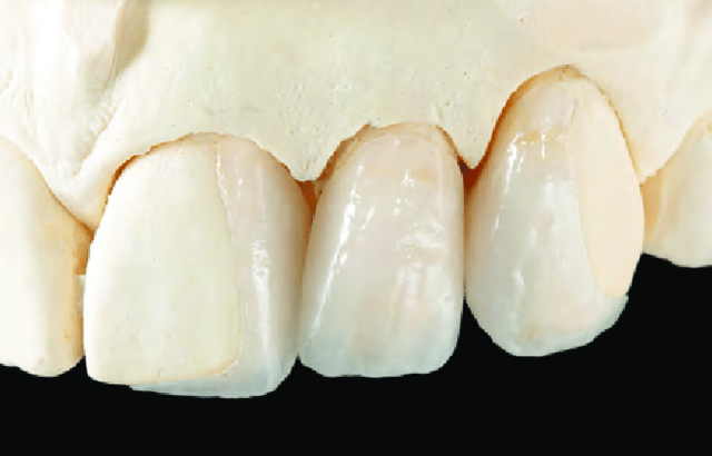 Restauraciones de Cerámica