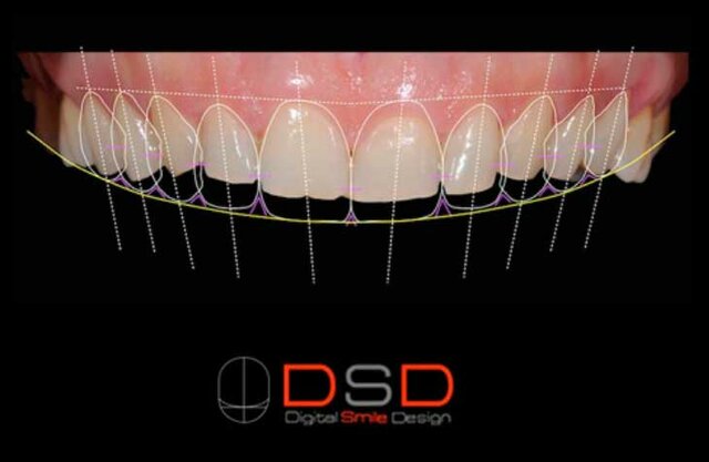 Diseño digital de la sonrisa