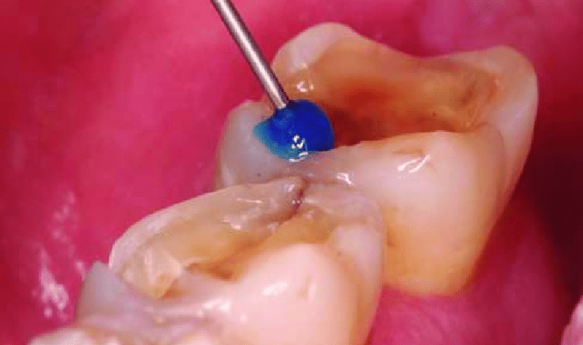 Técnica de grabado ácido