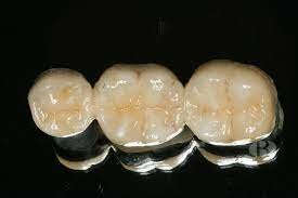 Comienzos del uso de Metaloceramicas