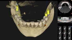 Primeros usos de la Tecnología CBCT